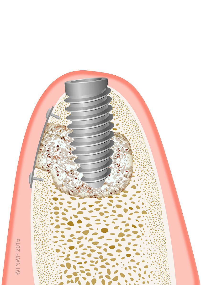 Build up bone for dental implantsbone graftincrease bone volume in