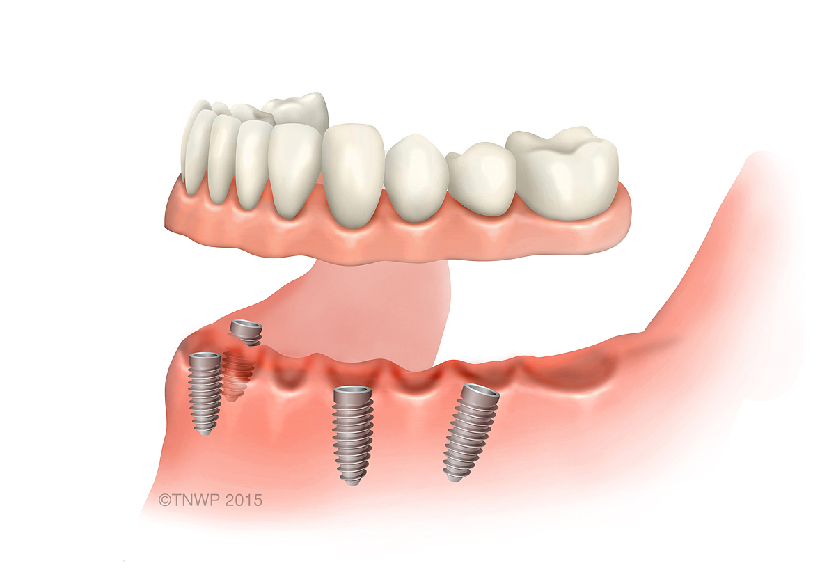 Lacking Jaw Bone? – All On 4 Dental Implants