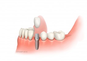 Dental Implants Mt Pleasant Sc